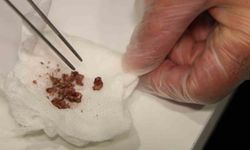 Elazığ'da estetik ameliyatta şaşırtan olay, burundan taş çıktı