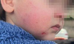 Kreşe bıraktığı çocuğunu darp edilmiş halde aldı