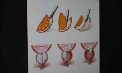 Erkeklerde sinsi tehlike çoğu zaman belirti vermiyor