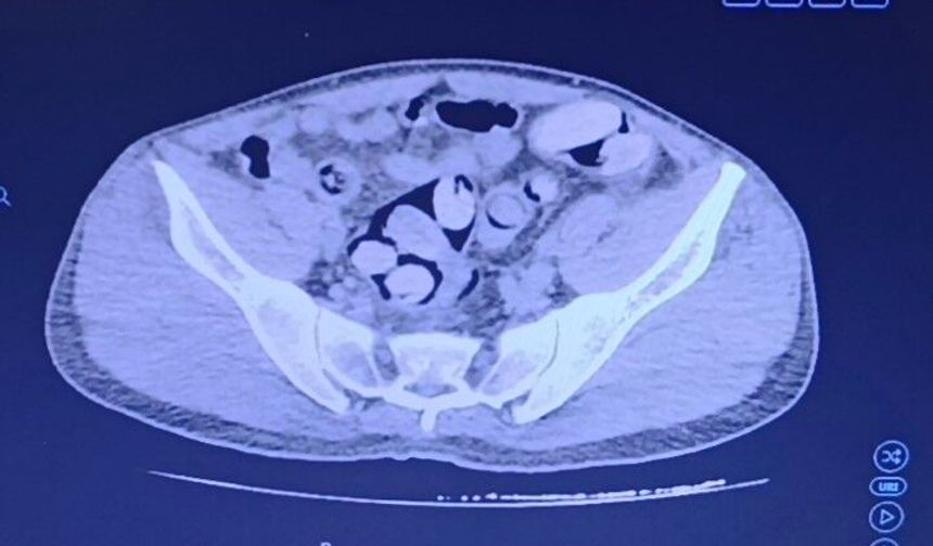 Midesinden 1 kilo uyuşturucu çıktı